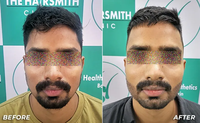 Beard Transplant