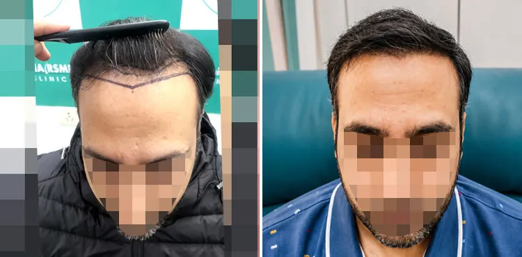 Body Hair Transplant