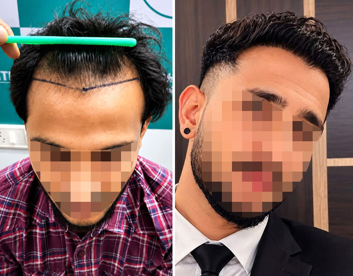 Hairsmith Hair Transplant — UR-FUE Hair Transplant