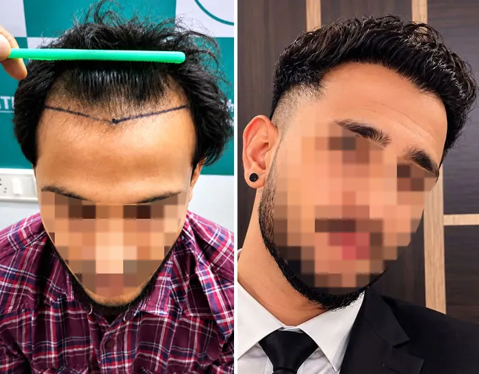 UR-FUE hair transplant result