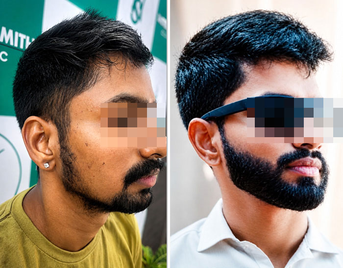 Beard Hair Transplant — UR-FUE Hair Transplant