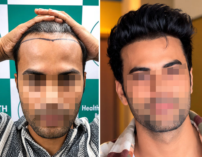 Hairsmith Hair Transplant — UR-FUE Hair Transplant