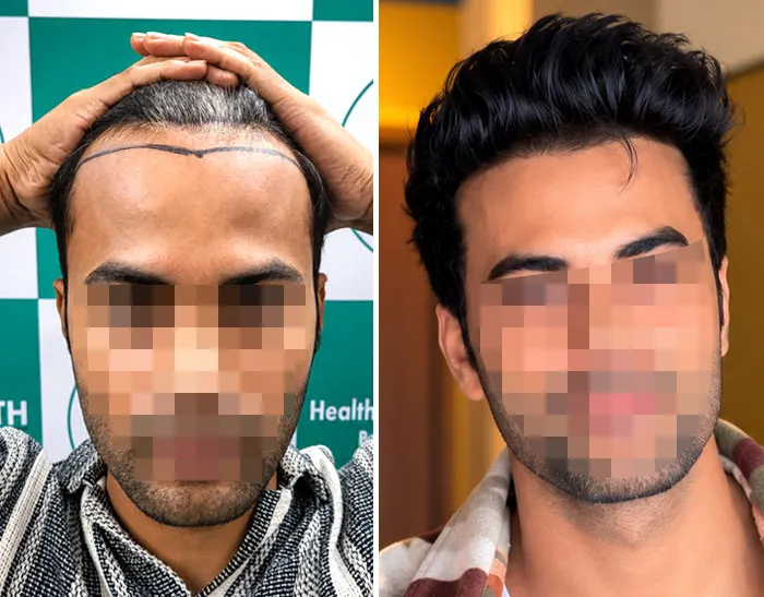 Patient result after a UR-FUE transplant