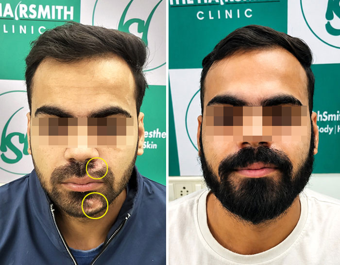 Scar Beard Transplant — UR-FUE Hair Transplant