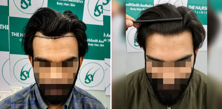 Follicular grafts counted and sorted on a chilled tray