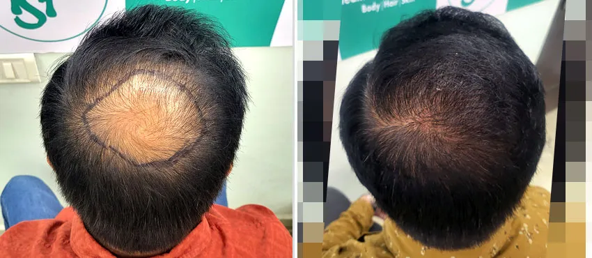 Crown Transplant