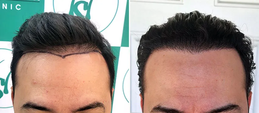 Hairline Reconstruction