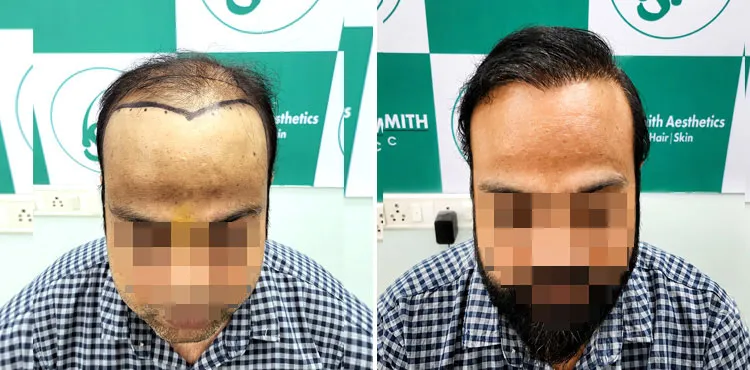 Hair transplant growth tracked month by month