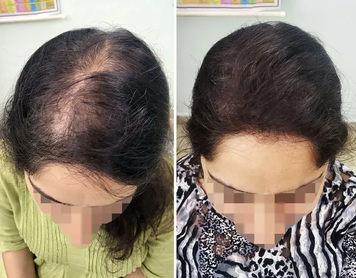 PRP Therapy