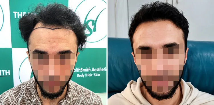 Scalp Micropigmentation
