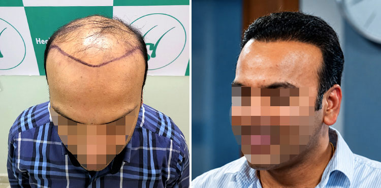 UR-FUE Hair Transplant